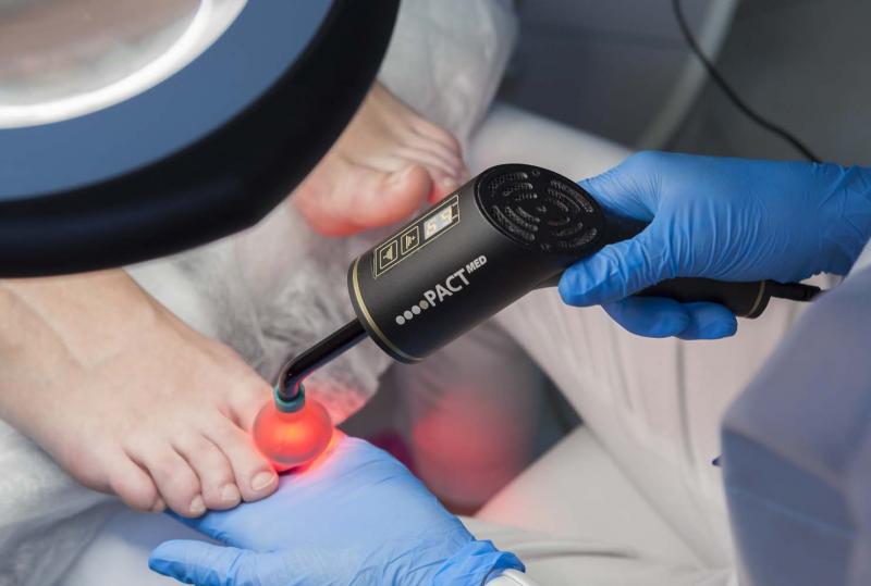 Подологическая процедура лечения грибка ногтей с помощью процедуры фототерапии